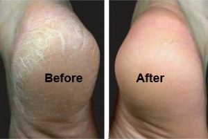 Heel-Crack before and after